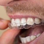 Wybielanie zębów – przegląd metod i kosztów